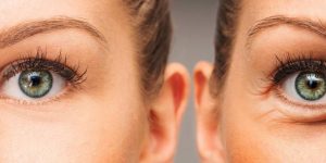 Ботоксът: Ефикасен и безопасен, но с мярка